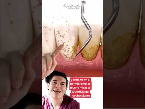 Limpiador De Dientes Quita Sarro Raspado
